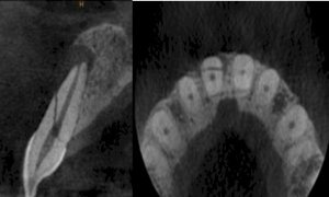 Inmersión en Tomografía Cone Beam en Endodoncia 
