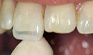 Curso de Carillas Lentes de Contacto